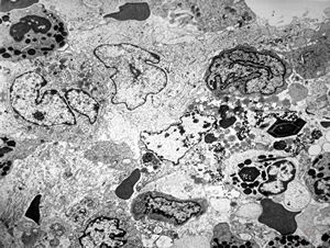 M,15y. | eosinophilic granuloma M,15y. | eosinophilic granuloma